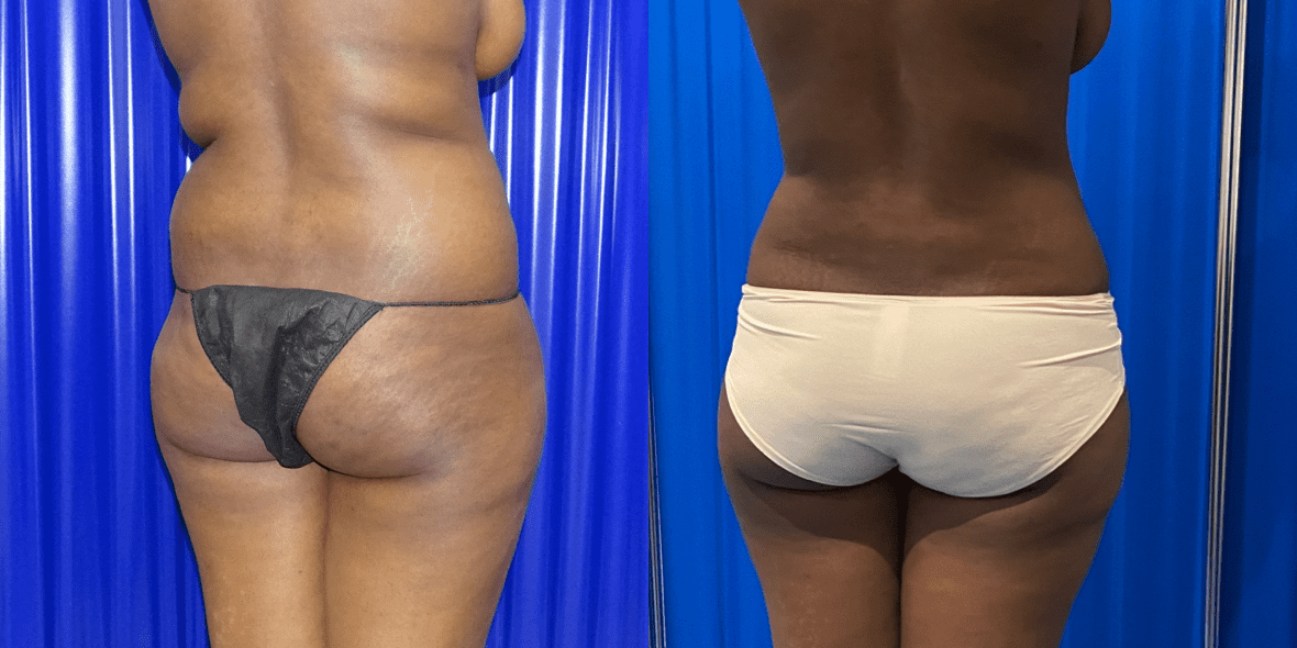 Liposuction Before/ After - Back View