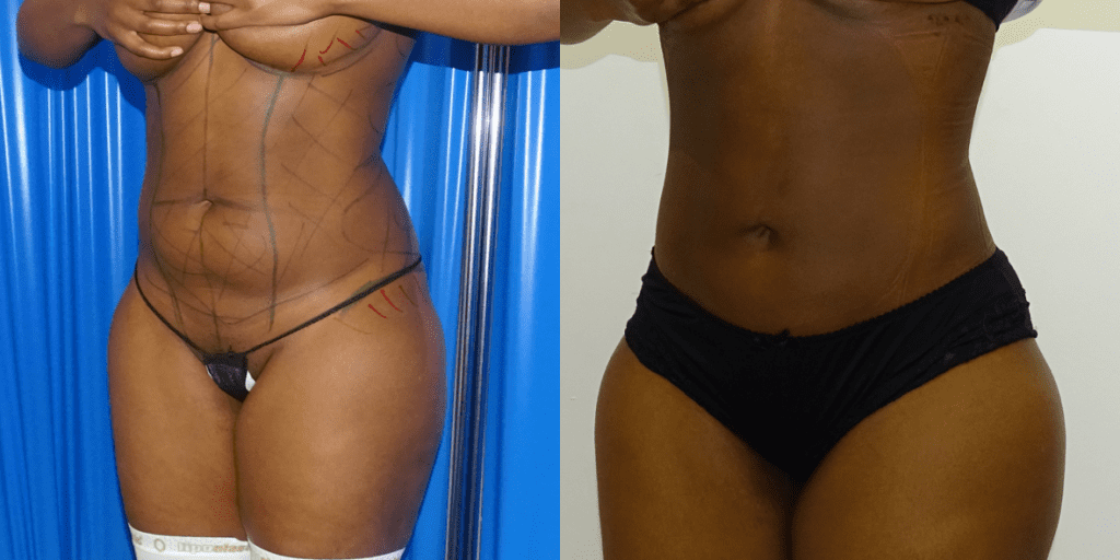 Liposuction Before/ After - Front View