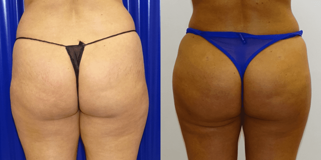 Brazilian Butt Lift Before/ After - Close-Up