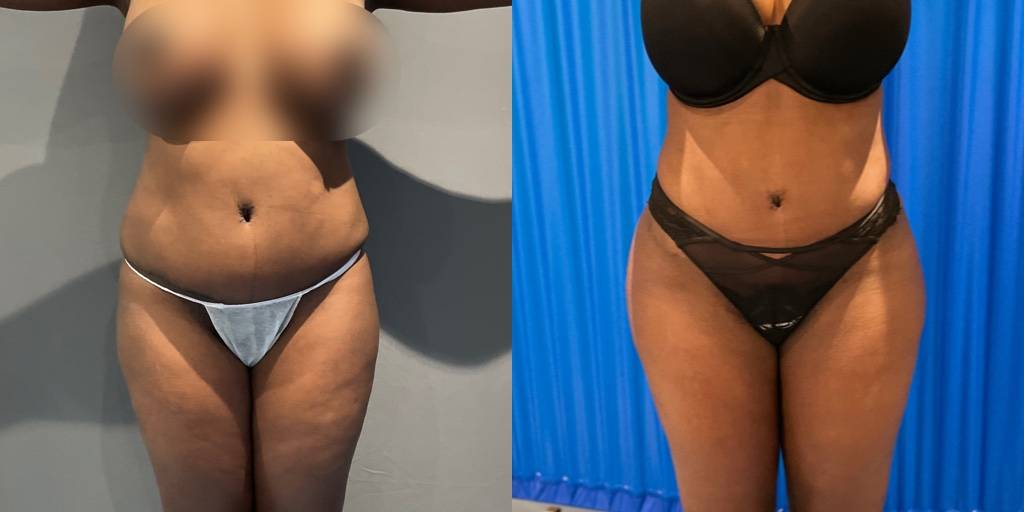 Brazilian Butt Lift Before and After Front View
