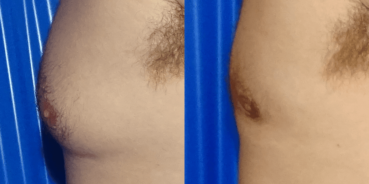 Gynecomastia Before/ After - Right Breast Close-Up