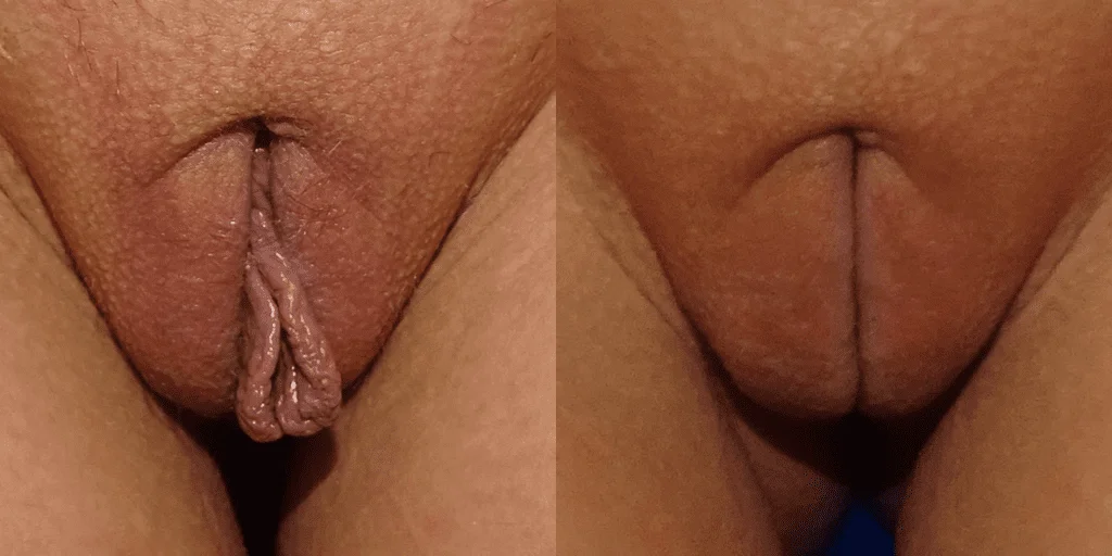 Labiaplasty London, Uk