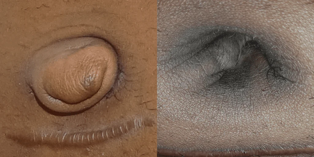 Umbilicoplasty