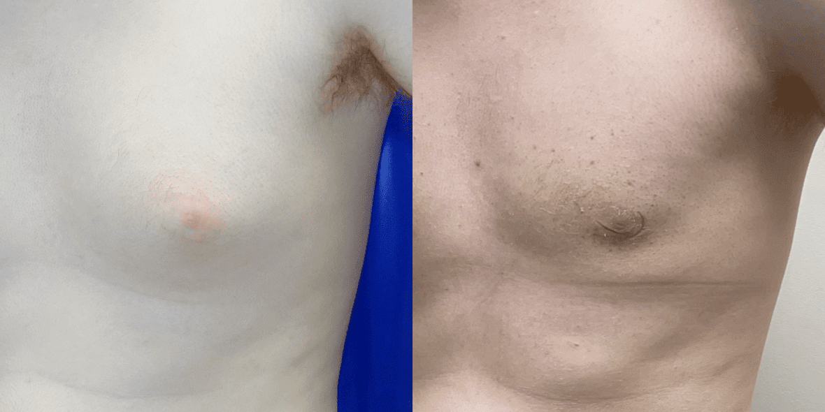 Gynecomastia Before/ After - Left Breast