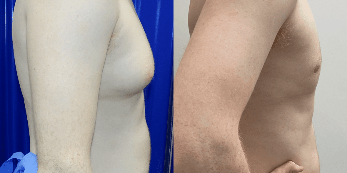Gynecomastia Before/ After - Left Breast