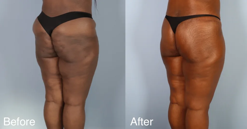 Patient Before And After A Buttock Lift