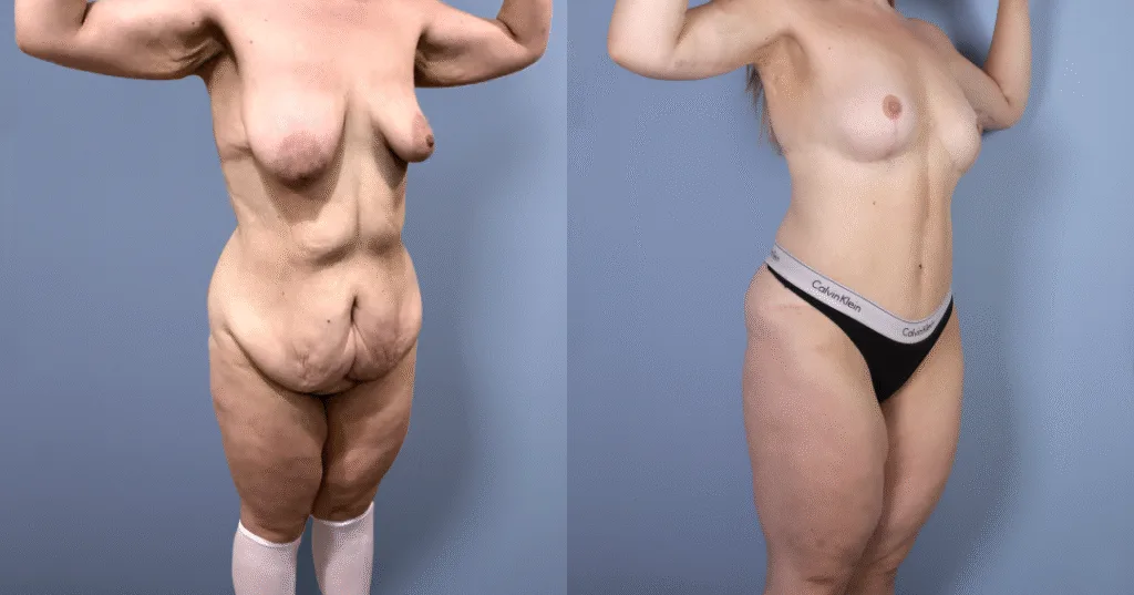 A Patient Before And After A Mummy Makeover