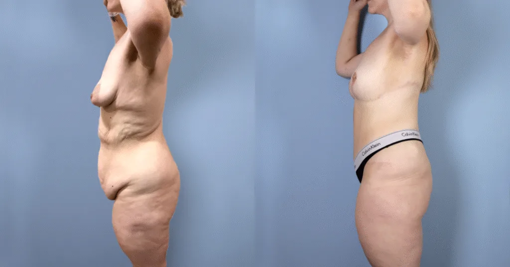 A Patient Before And After A Mummy Makeover