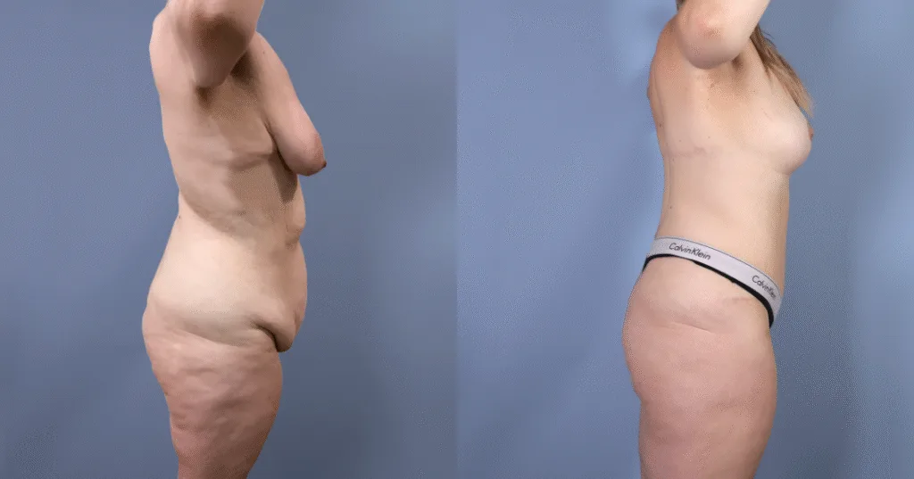 A Patient Before And After A Mummy Makeover
