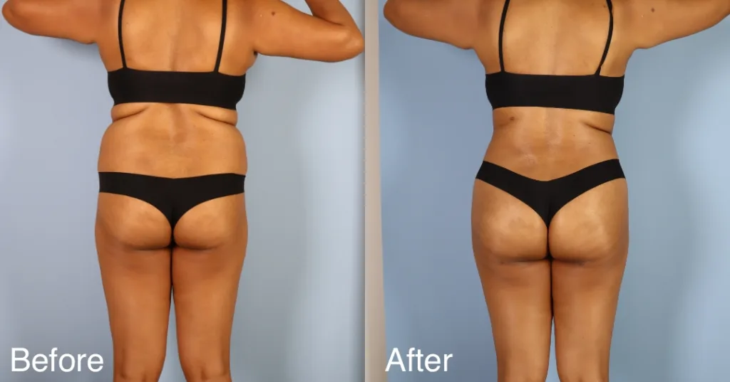 patient before and after BBL