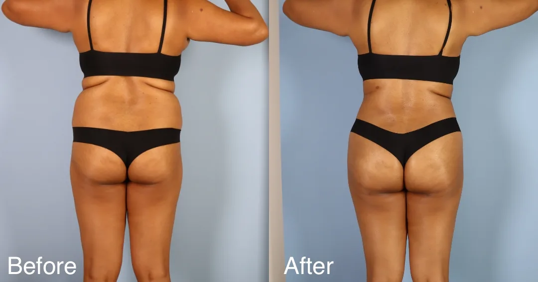 Patient Before And After Bbl