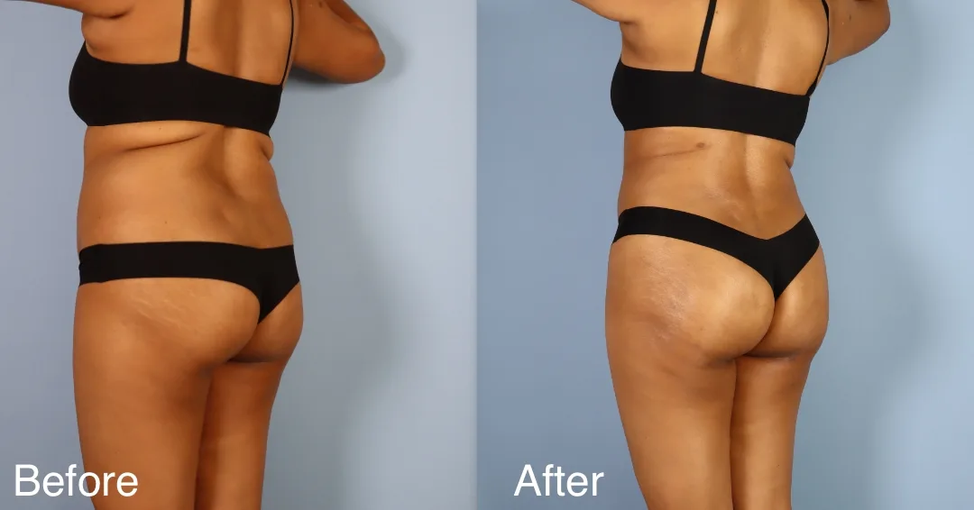 Patient Before And After Bbl
