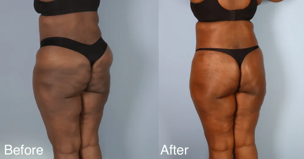 Patient Before And After A Buttock Lift
