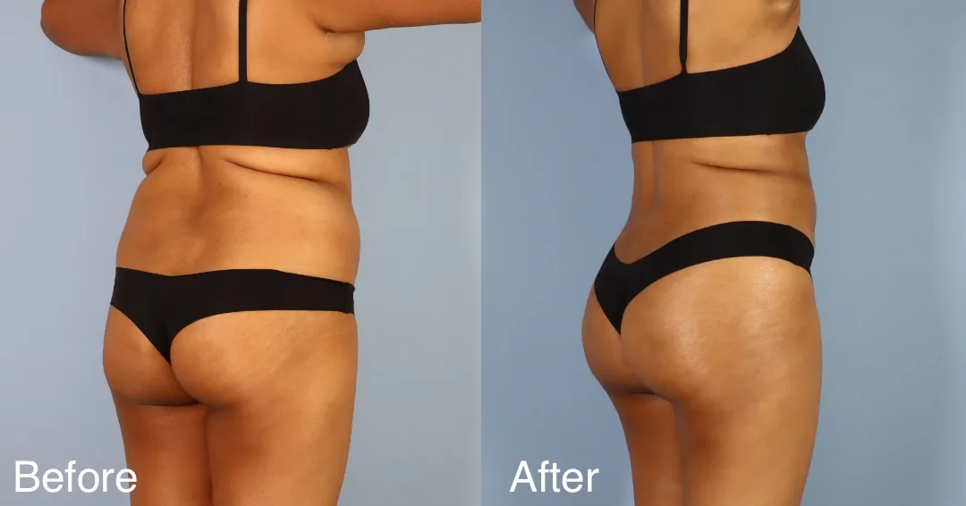 Patient Before And After Bbl
