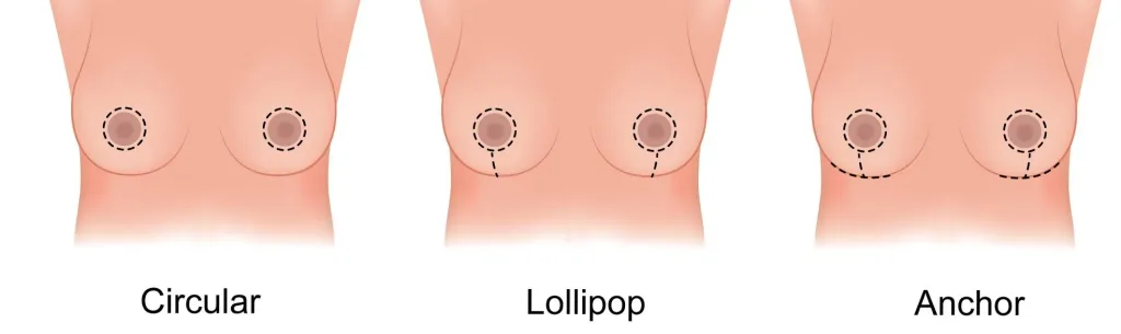 Breast Reduction Surgery In London
