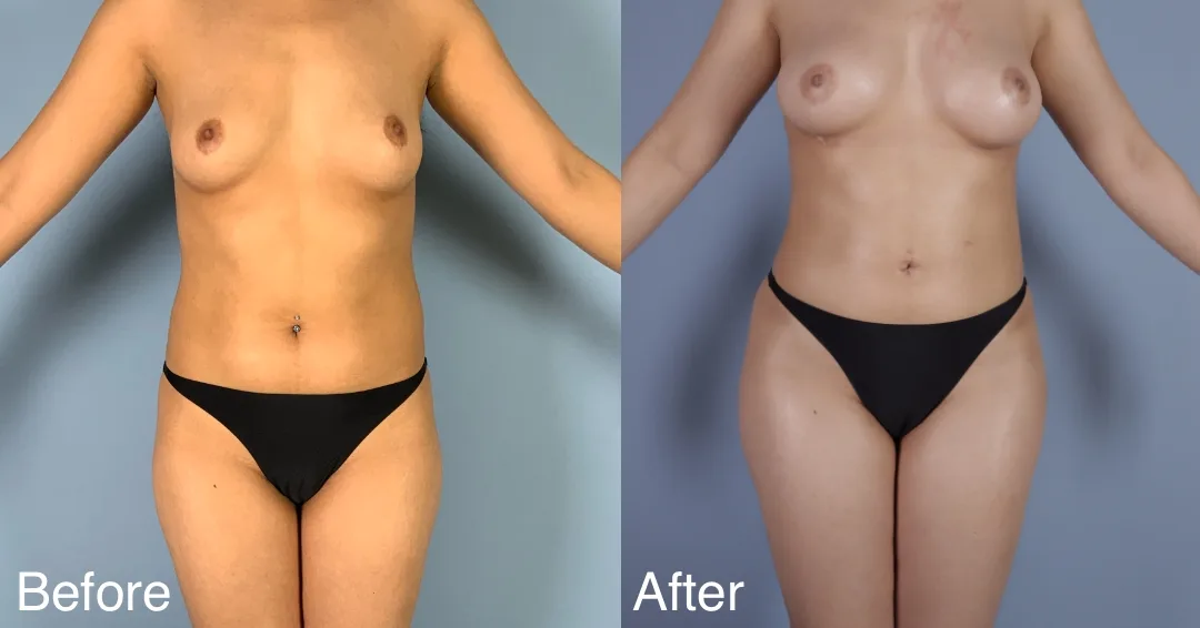 Patient Before And After Fat Transfer To The Hips