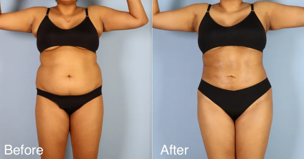 patient before and after BBL