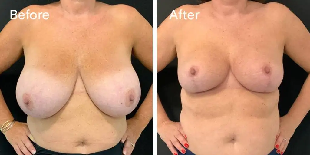 Breast Reduction Before And After