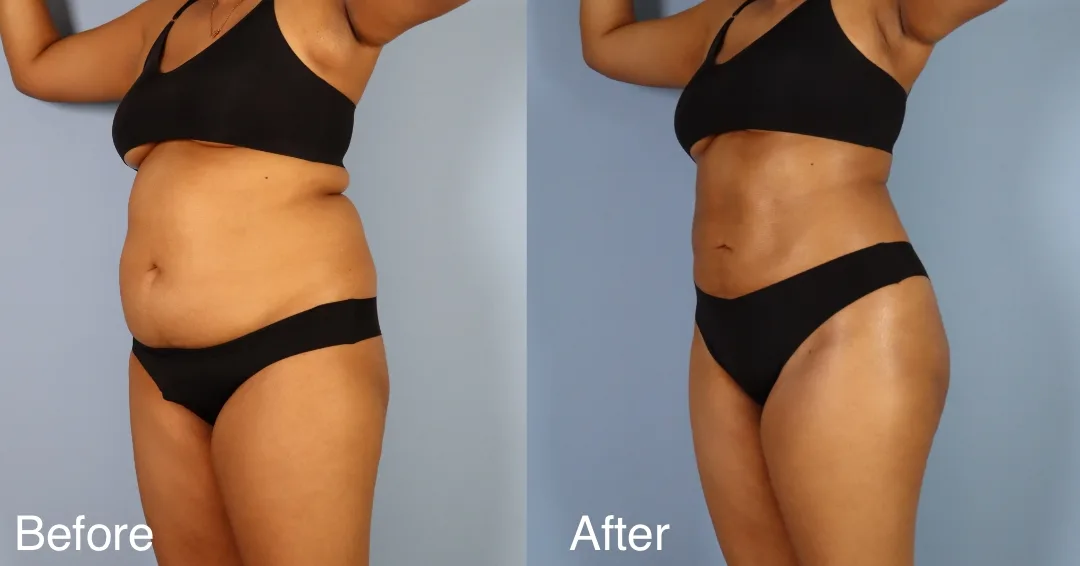 Patient Before And After Bbl