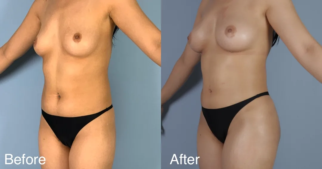 Patient Before And After Fat Transfer To The Hips