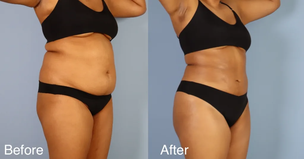 patient before and after BBL