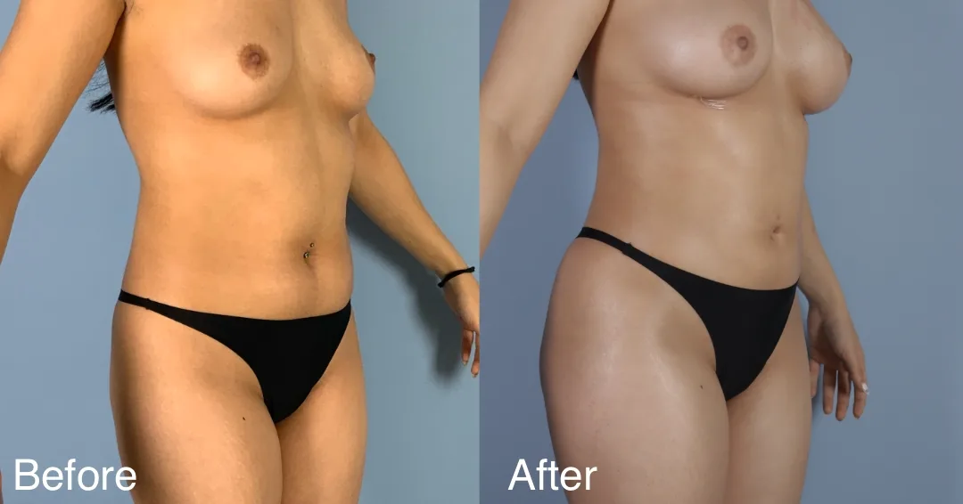 Patient Before And After Fat Transfer To The Hips