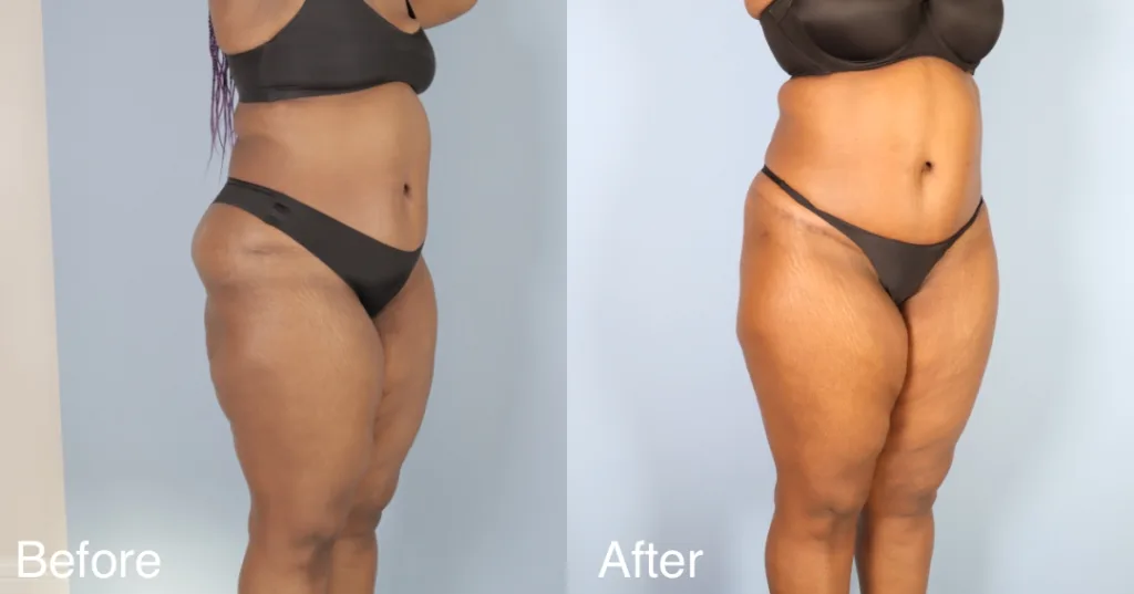 Patient Before And After A Buttock Lift
