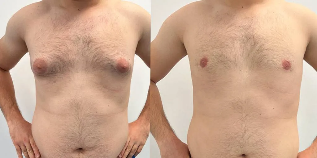 03.23 Gynecomastia Front