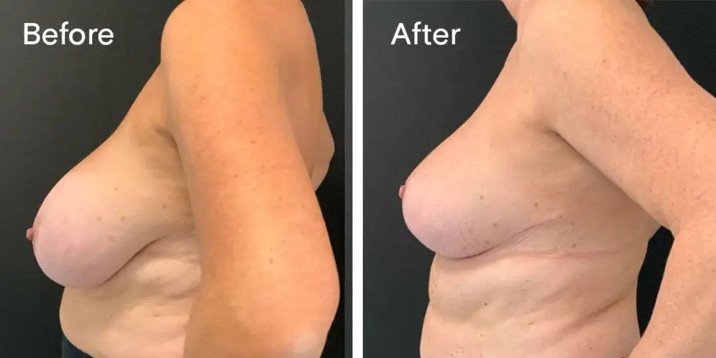 Breast Reduction Before And After