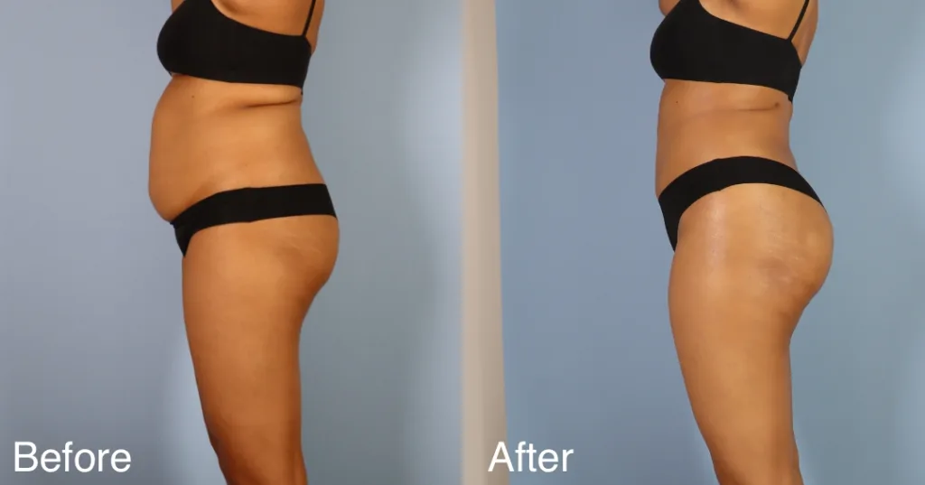 patient before and after BBL