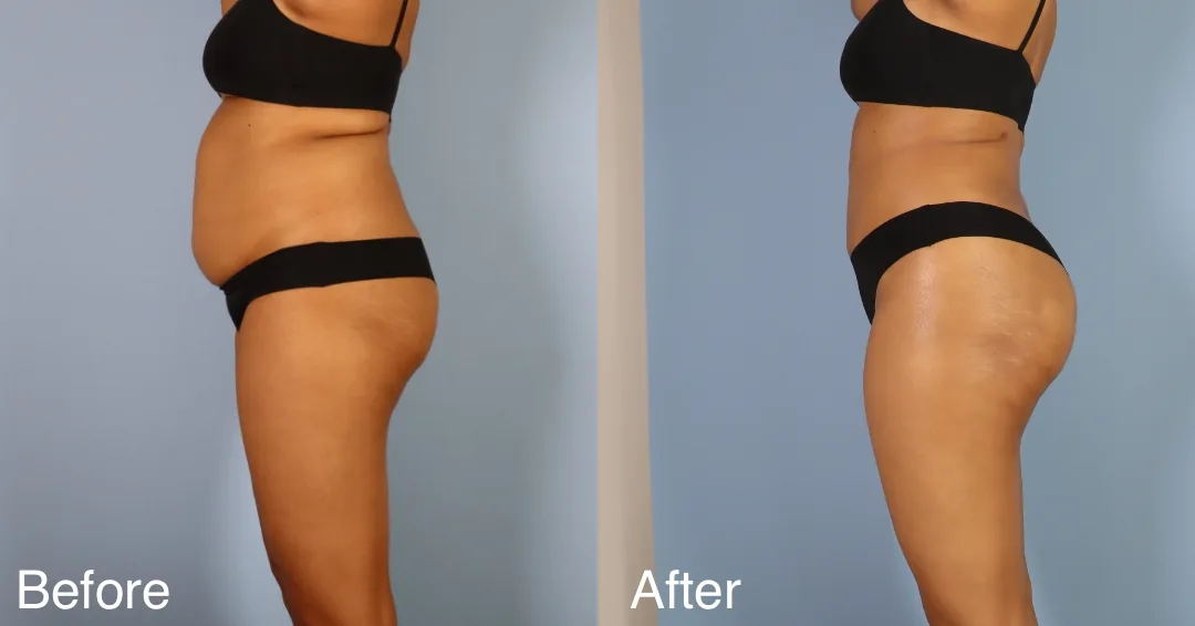 Patient Before And After Bbl