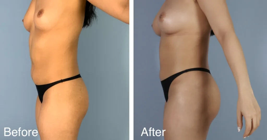 patient before and after fat transfer to the hips