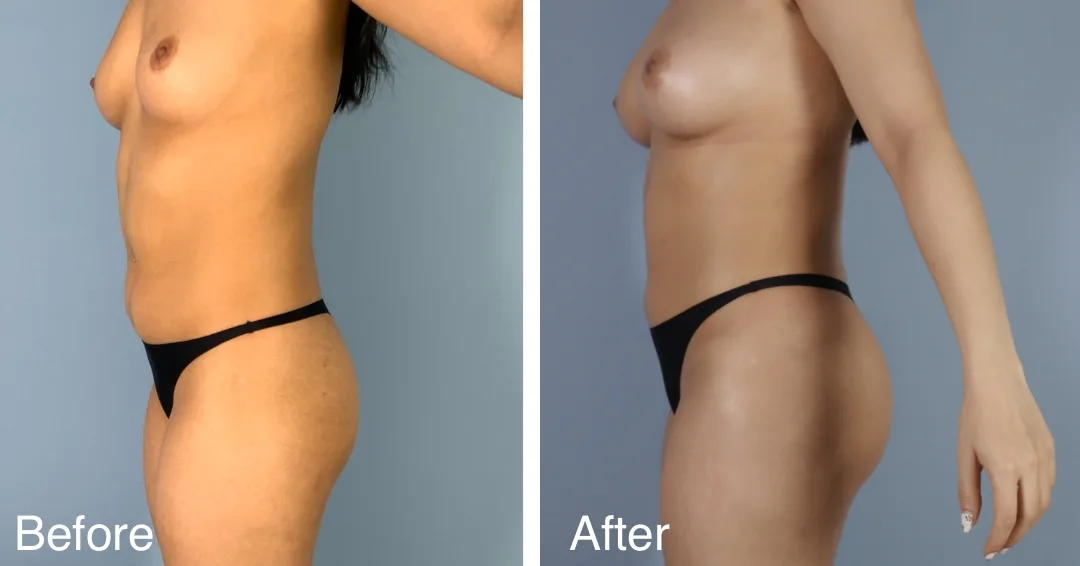 Patient Before And After Fat Transfer To The Hips