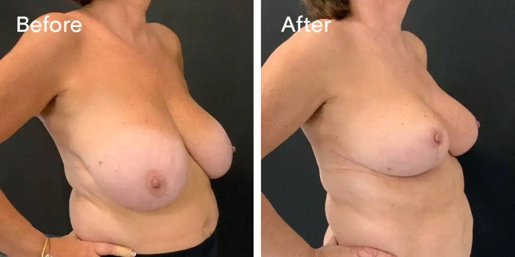 Breast Reduction Before And After