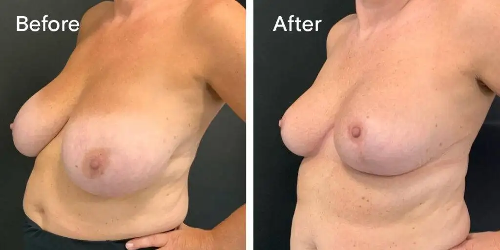 Breast Reduction Before And After