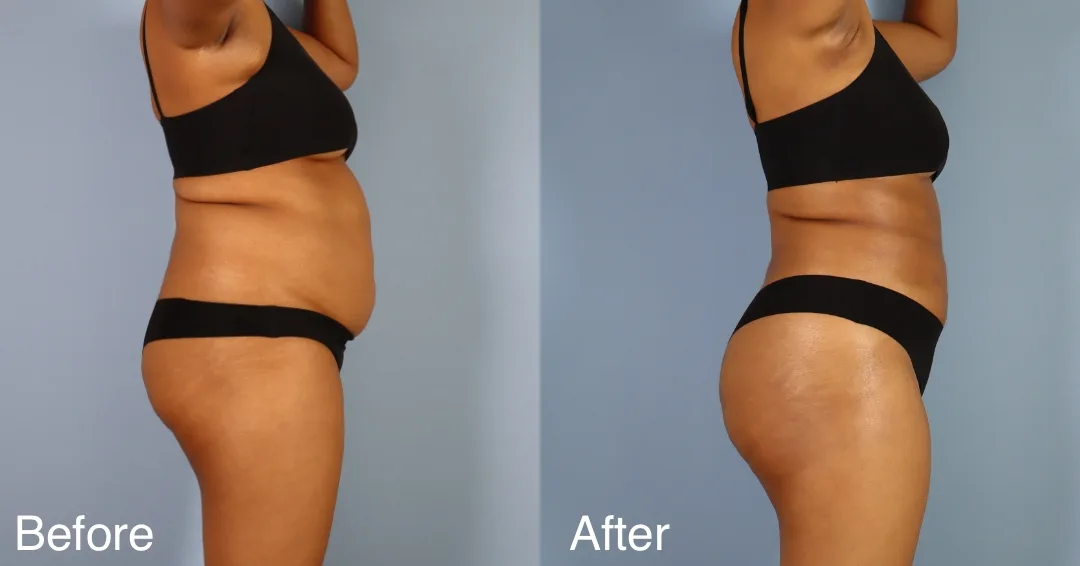 Patient Before And After Bbl