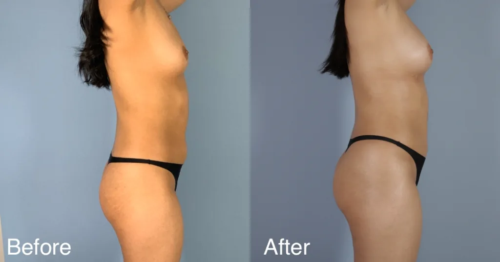 patient before and after fat transfer to the hips