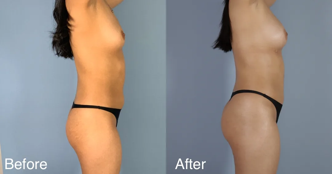 Patient Before And After Fat Transfer To The Hips