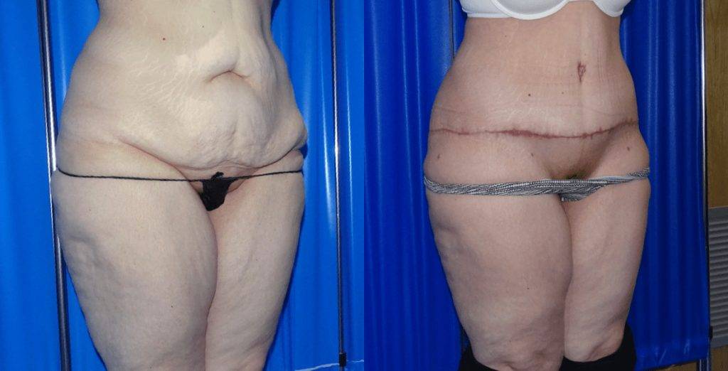 A before and after of abdominoplasty with some scarring.