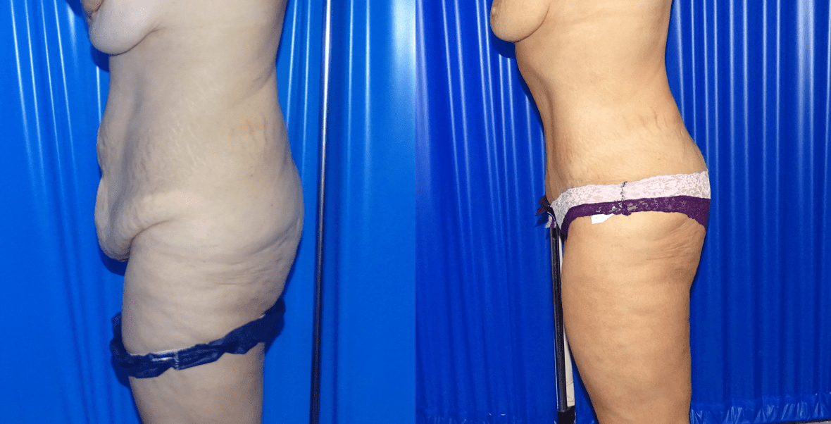 Tummy Tuck Before And After - Side