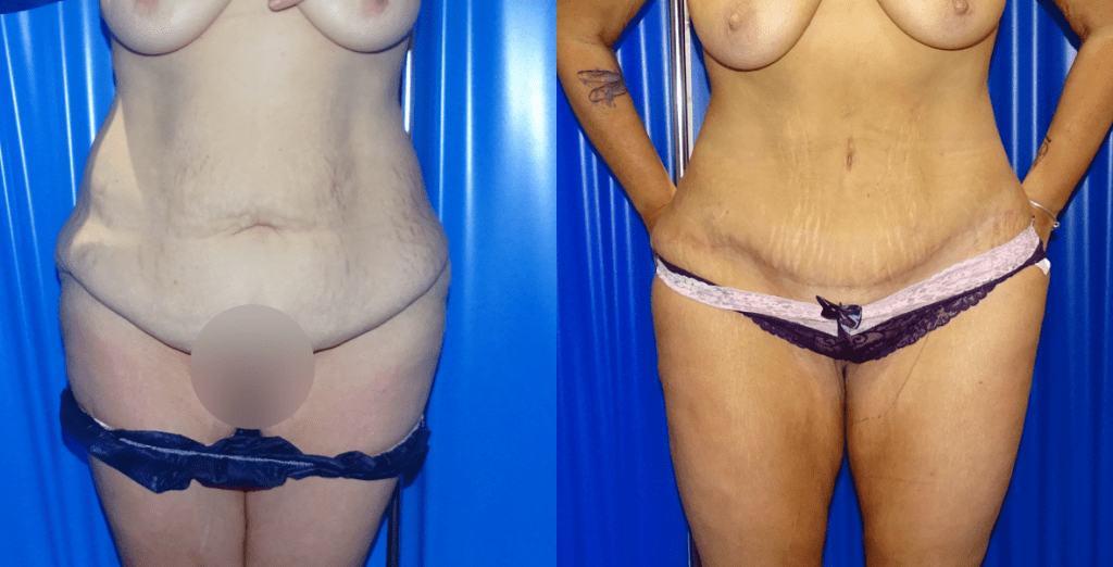 A front facing before and after of abdominoplasty.