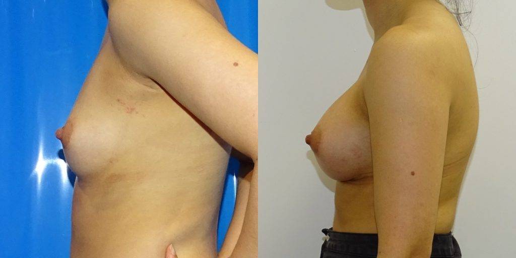 Before and after of a woman's breast augmentation.