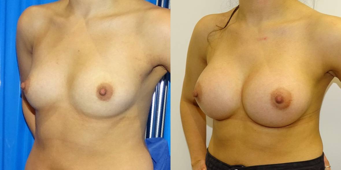 Fat Transfer Vs Breast Implants
