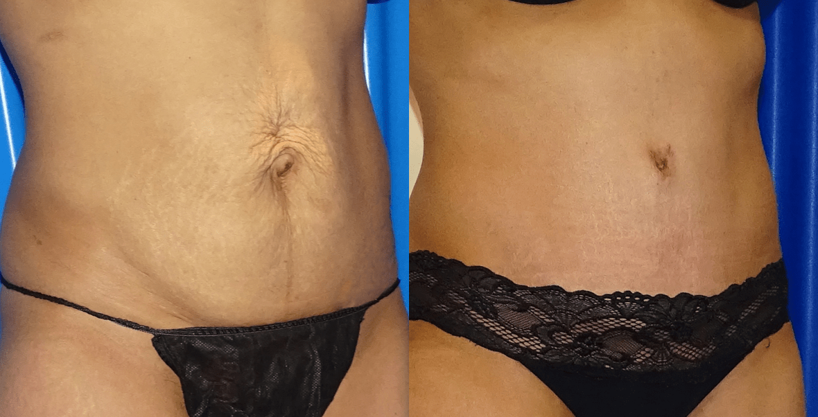 Tummy Tuck For Loose Skin