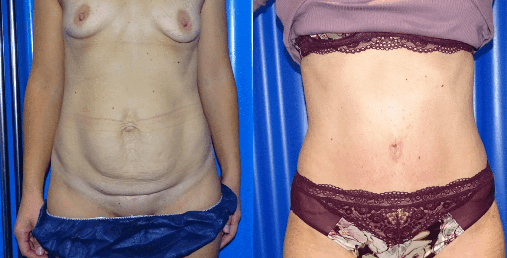 Tummy Tuck In London