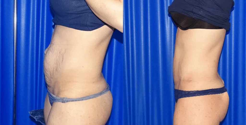 Tummy Tuck Before And After - Side