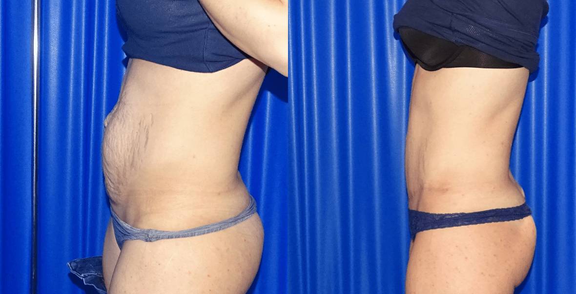 Tummy Tuck Before and After - Side
