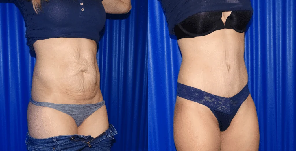 Tummy Tuck Before And After