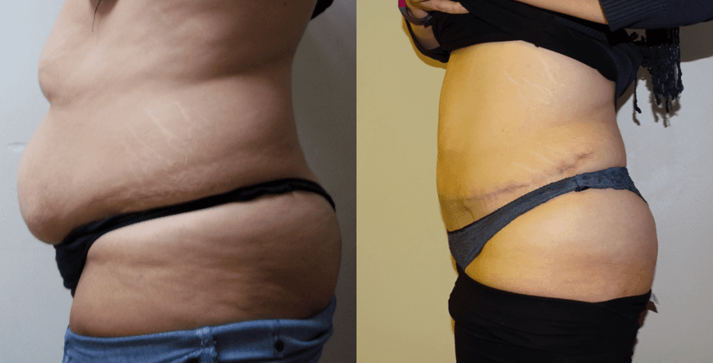 Before and after gallery for abdominoplasty.