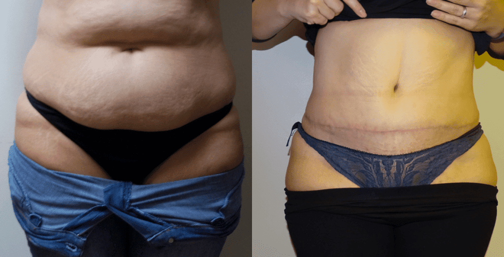 Before and after gallery for abdominoplasty.